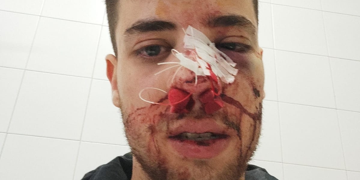 Pau Vilaró, después de la agresión | Vilassar